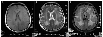 Novel compound heterozygous mutations of LAMA2-limb–girdle muscular dystrophy: A case report and literature review